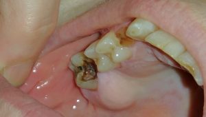 Tooth-Infection